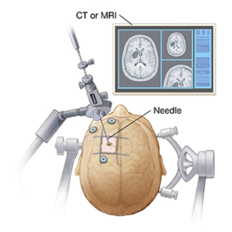 استخدام جهاز الاستريوتاكسى (جهاز الملاحة ثلاثى الابعاد) في أخذ عينة من أورام المخ عن طريق ابرة مع د محمد سالم