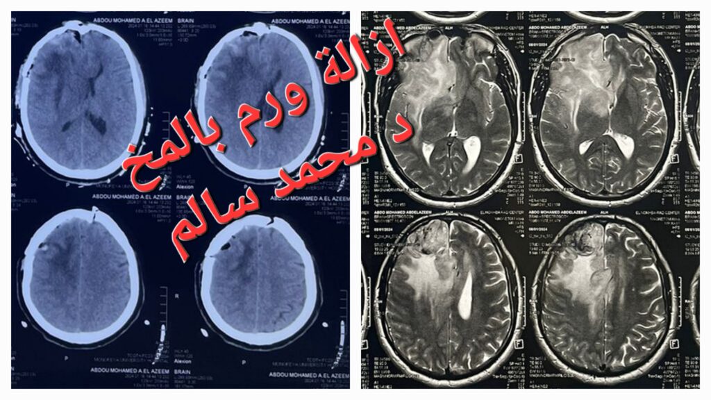 ازالة ورم بالمخ مع د محمد سالم