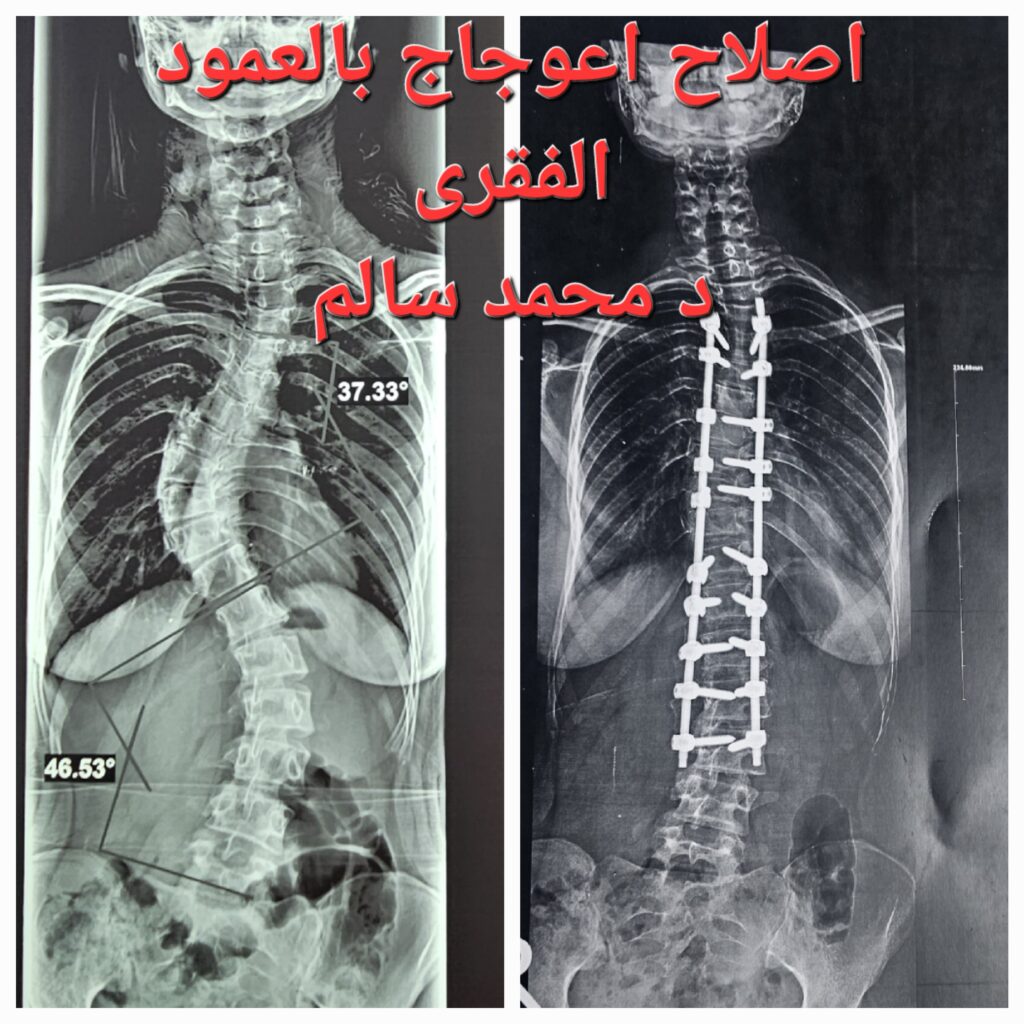 اصلاح اعوجاج العمود الفقرى مع د محمد سالم